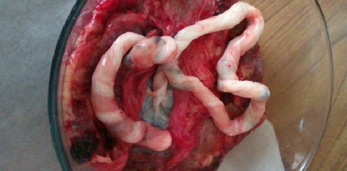 Umbilical cord close up